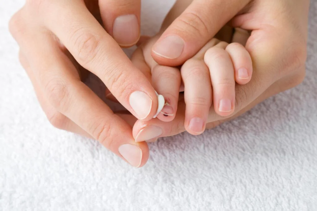 Petroleum Jelly for Wounds around Nails